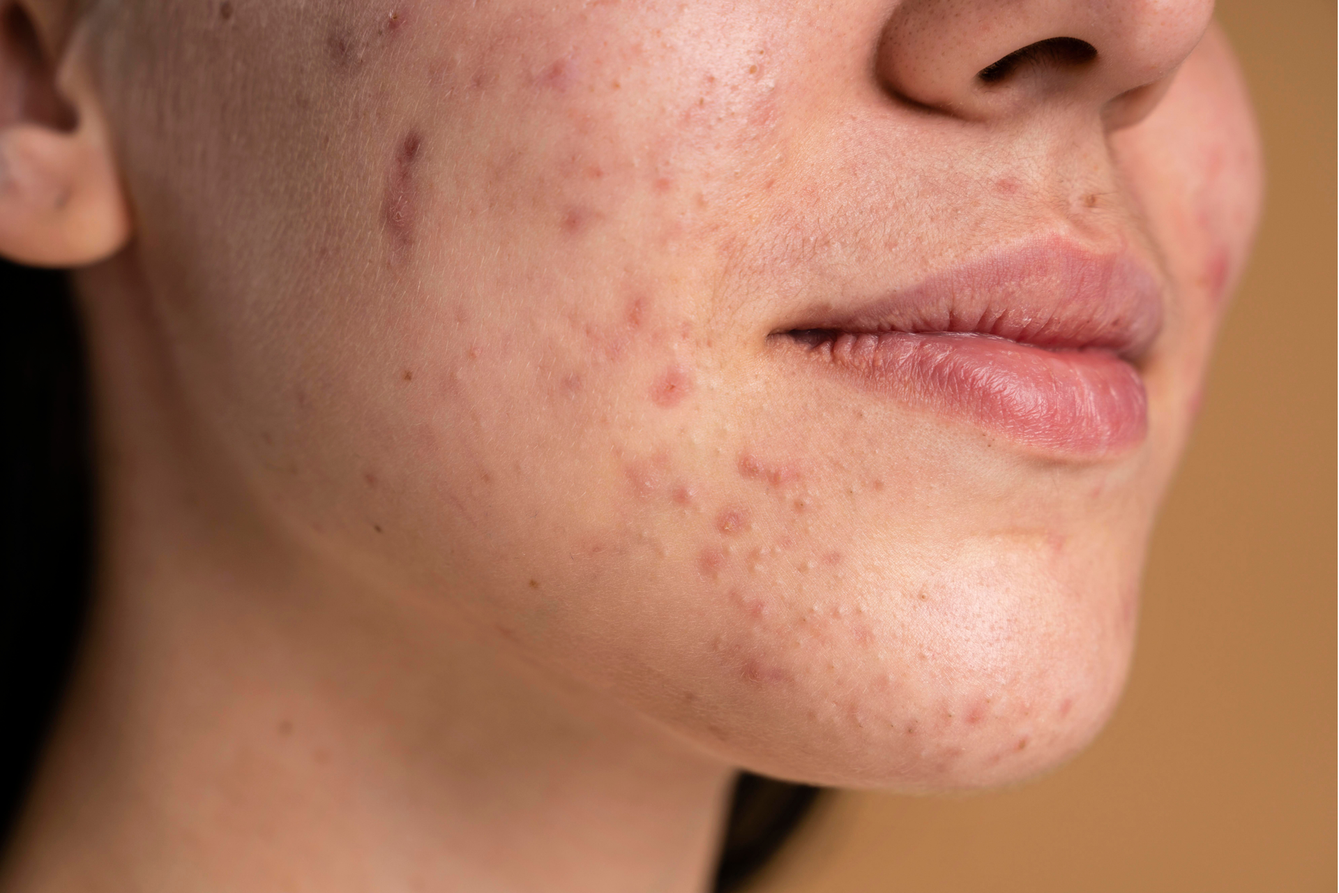 Hormonal Acne Explained: Causes, Symptoms & Best Treatment Options
