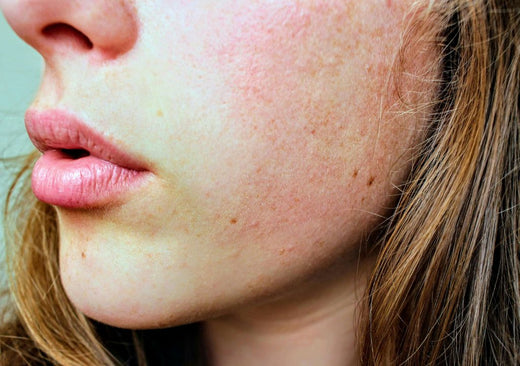 Damaged Skin Barrier? Read Our Tips On Repairing Damaged Skin