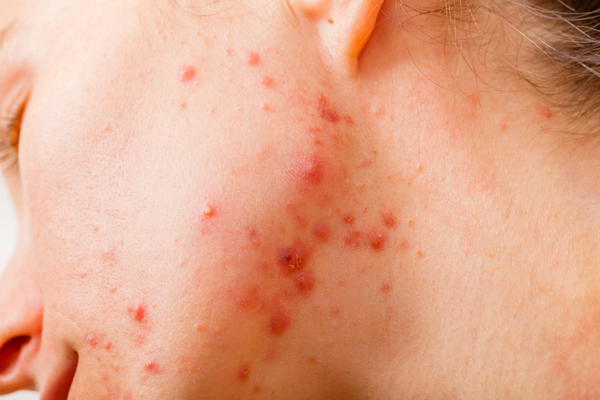 Chin and Jawline Acne: Hormones, Causes and Treatments