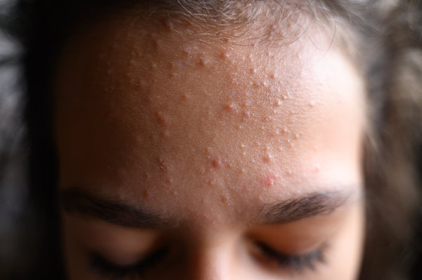 forehead acne