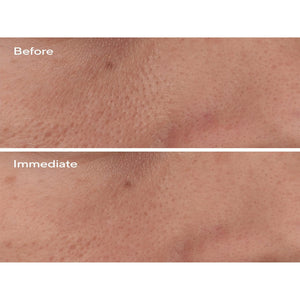 Murad Targeted Pore Corrector