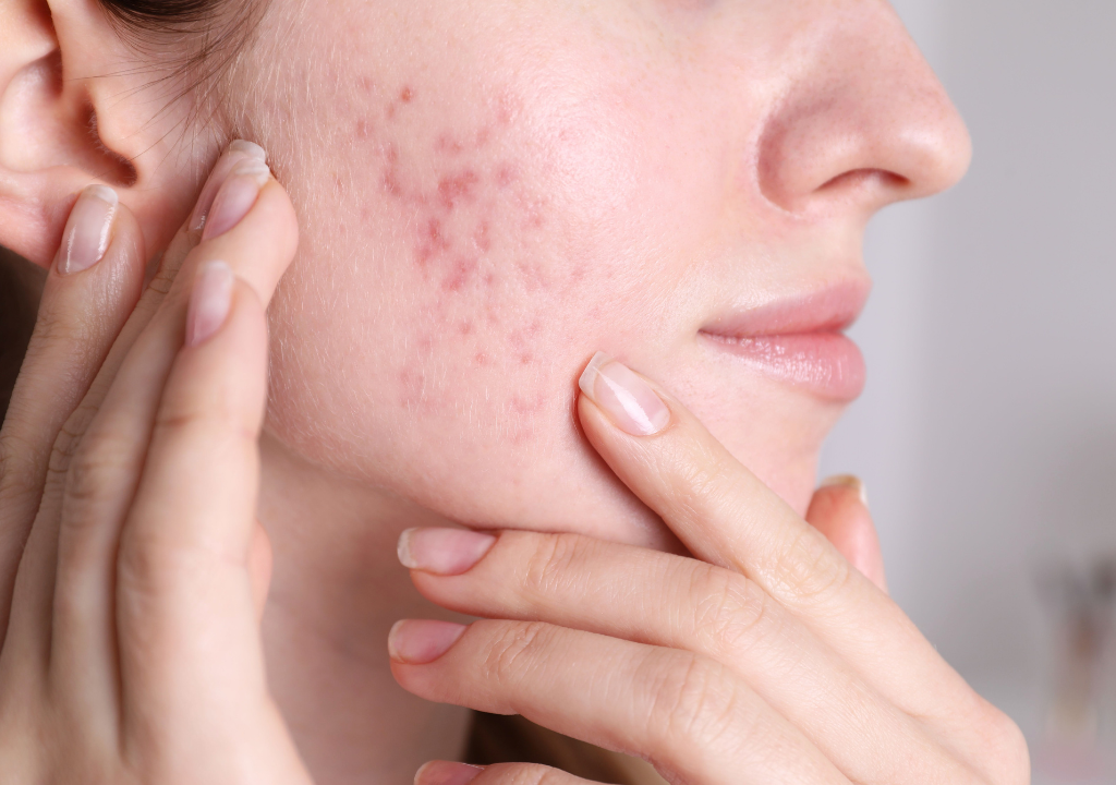 Acne Scar Treatment: What Works for Dark Marks vs Textured Scars