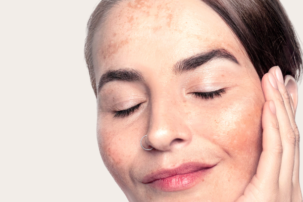 How To Reduce Pigmentation On Your Face: Expert Advice On Hyperpigmentation, Melasma And Dark Spots