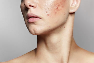 acne niacinamide 