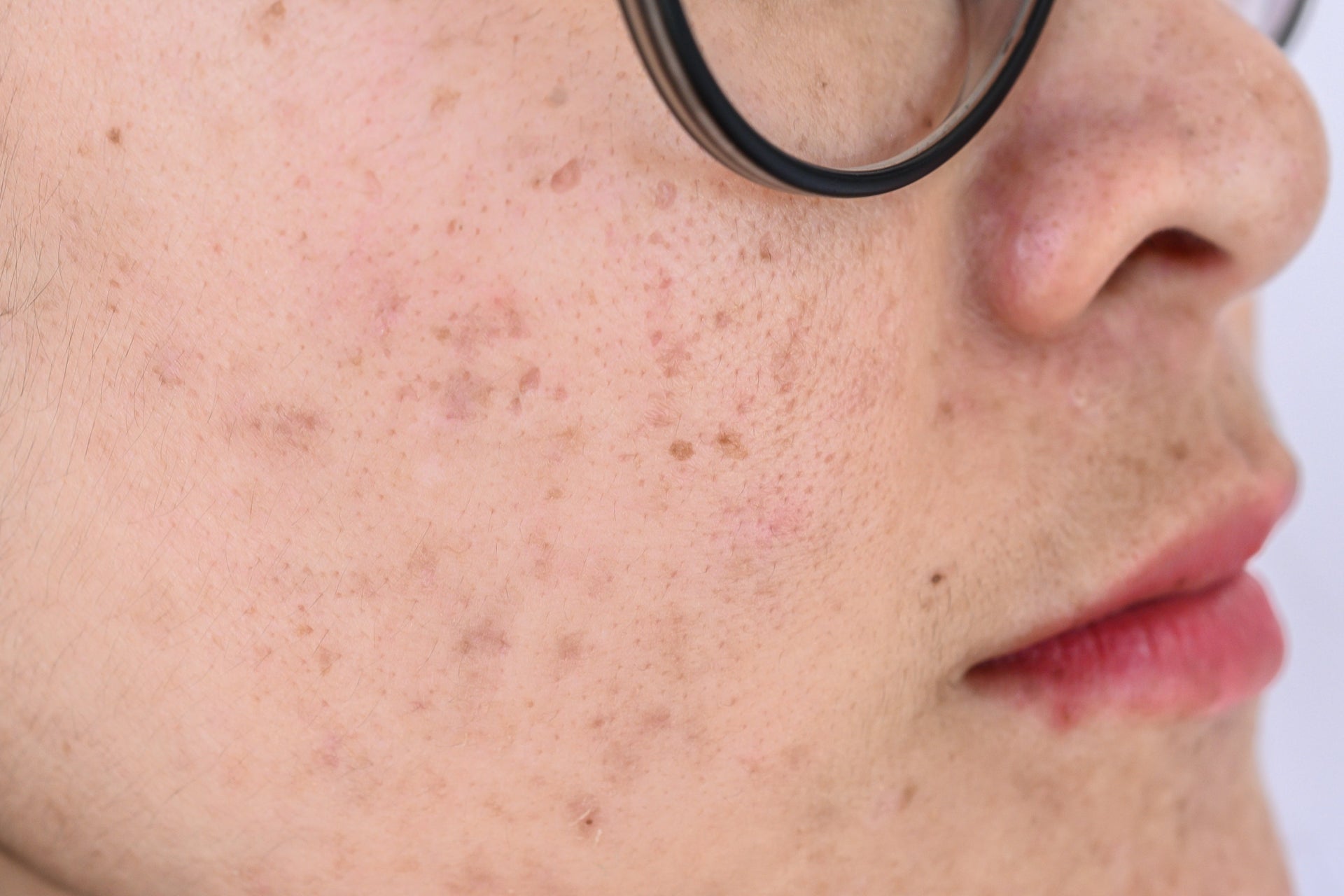 Fungal vs Hormonal Acne: How to Tell the Difference