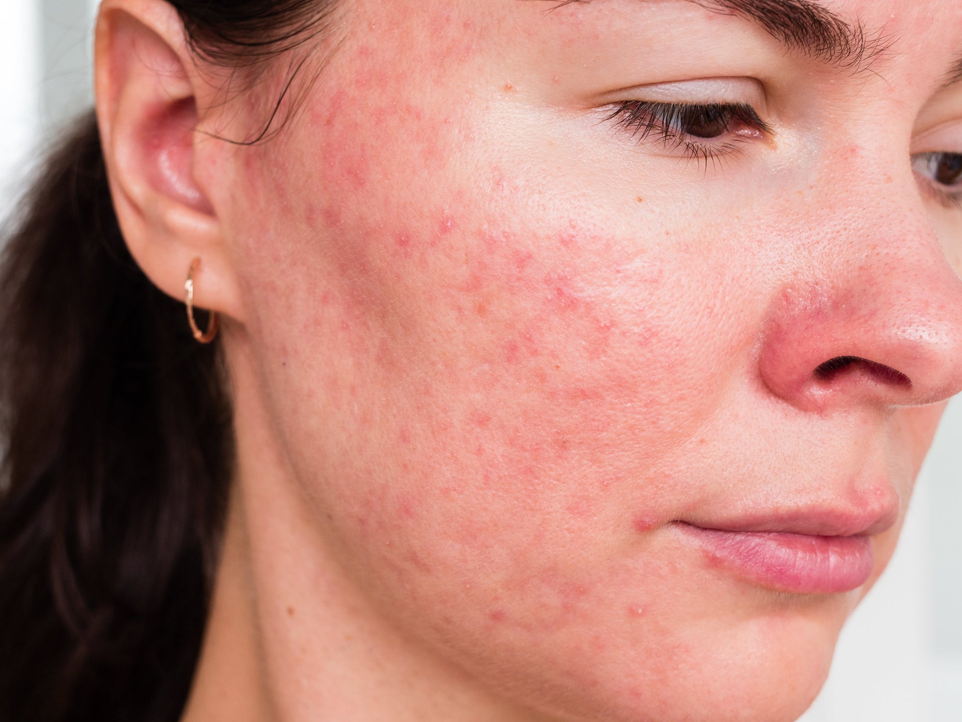 Close up of redness caused by acne.