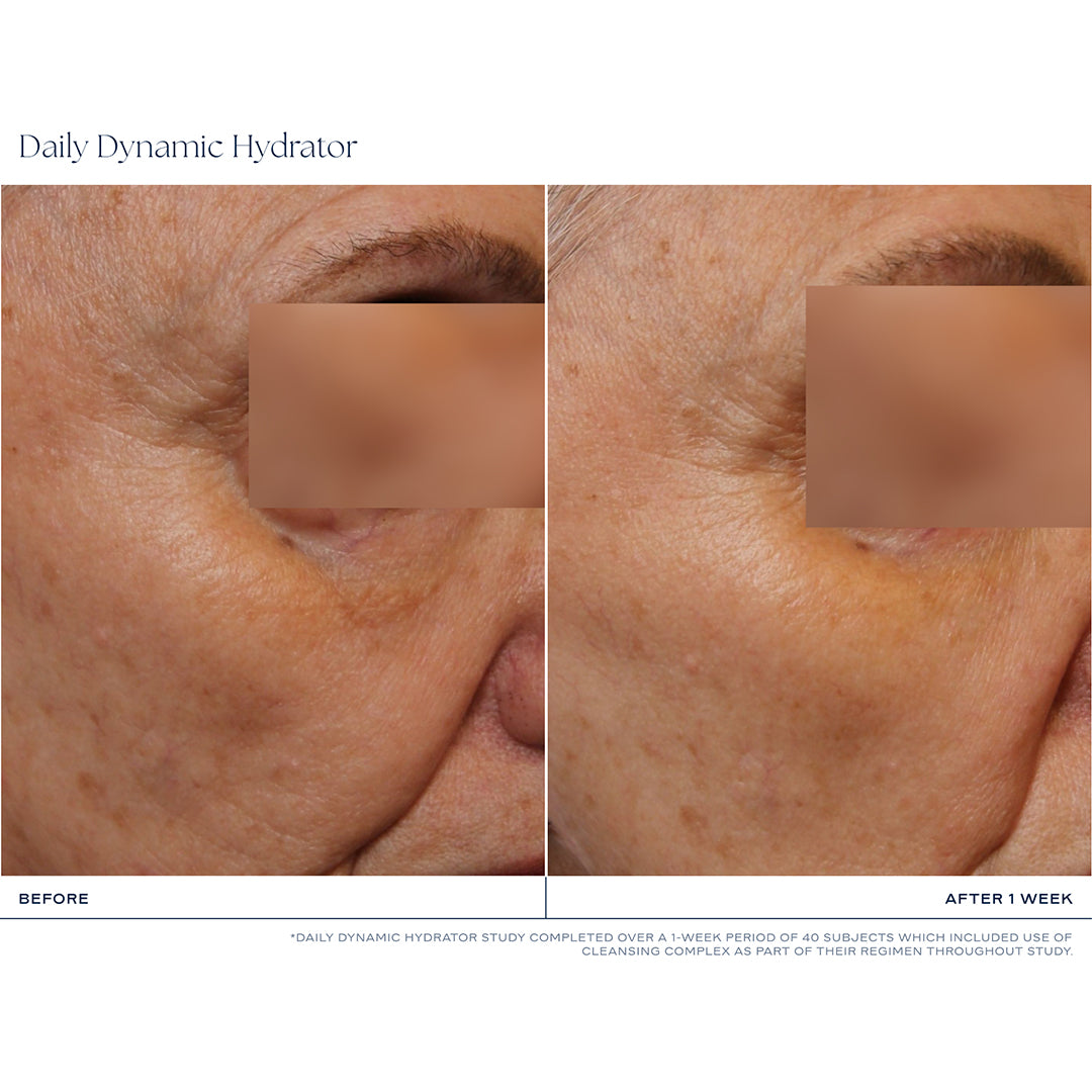 Before-and-after skin comparison of an older woman's face, showing visible wrinkles and sun damage on the left ('BEFORE') and smoother, more hydrated skin on the right ('AFTER 1 WEEK'). The eyes are obscured with rectangular privacy blocks, and the top and bottom text read 'Daily Dynamic Hydrator'.
