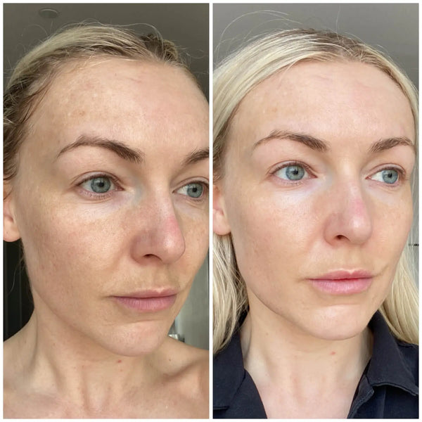 Before and after Ameliorate Resurfacing Facial Tonic