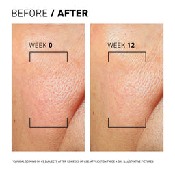 Before and after skin texture comparison on a person's face, showing improvement over 12 weeks.