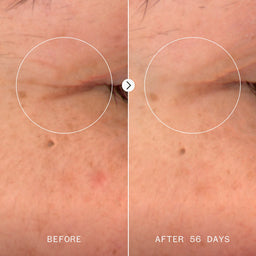 Before and after comparison of skin treatment on an eye area, showing improvement over 56 days.