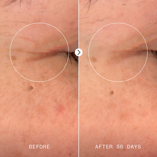 Before and after comparison of skin treatment on an eye area, showing improvement over 56 days.