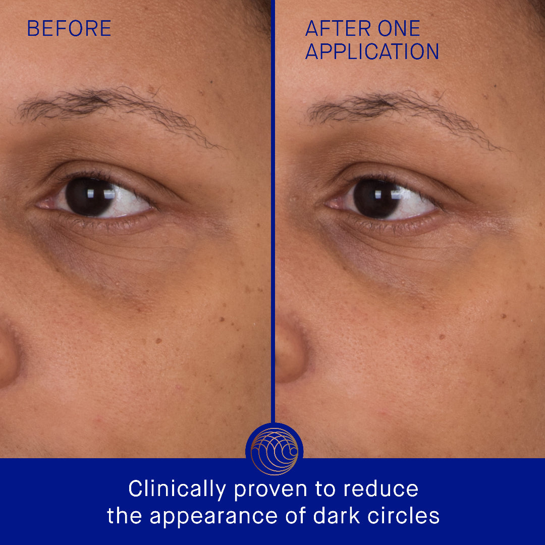 Before and after comparison of dark circles under eyes with a blue border and text.