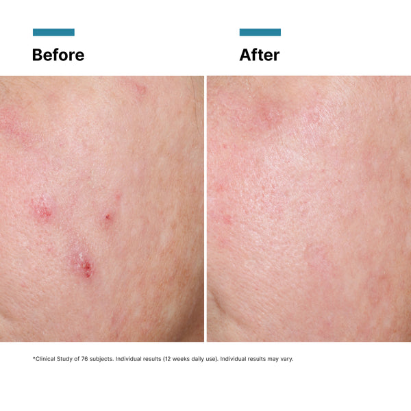 Before and after comparison of skin with acne treatment showing reduced blemishes.