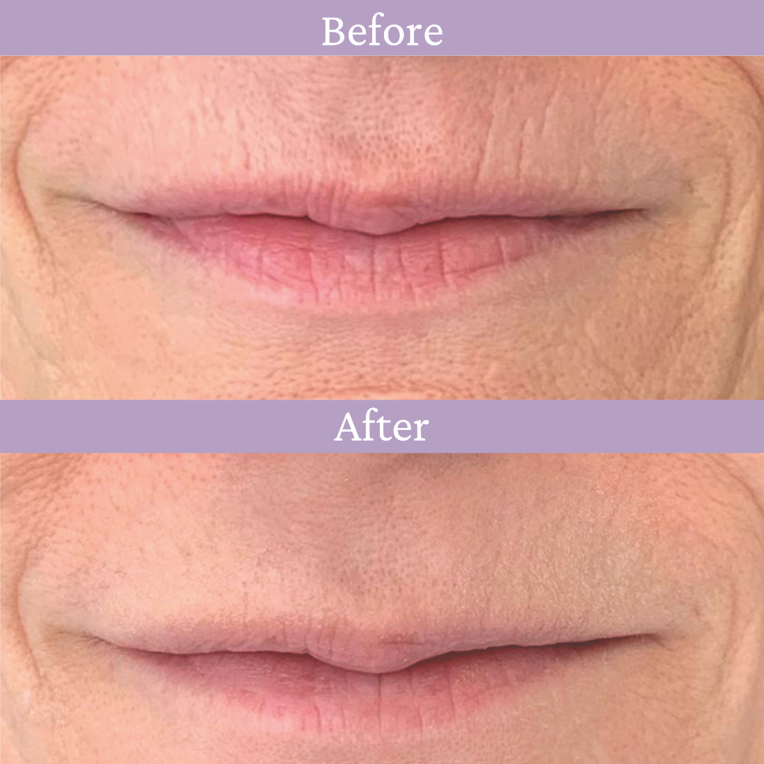 Prai Beauty Ageless Lip Line Filler - Thumbnail 4