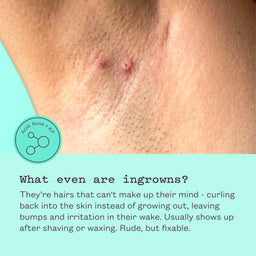 Close-up of a person's chest showing a few inflamed ingrown hair follicles, with explanatory text below on acne and ingrown hairs over a light aqua background.