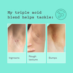 A promotional graphic on a mint green background with text reading 'My triple acid blend helps tackle:' and three inset close-up photos of skin showing ingrown marks, rough texture, and bumps. A small circular logo at top right says 'Acid Acne + AHA'.