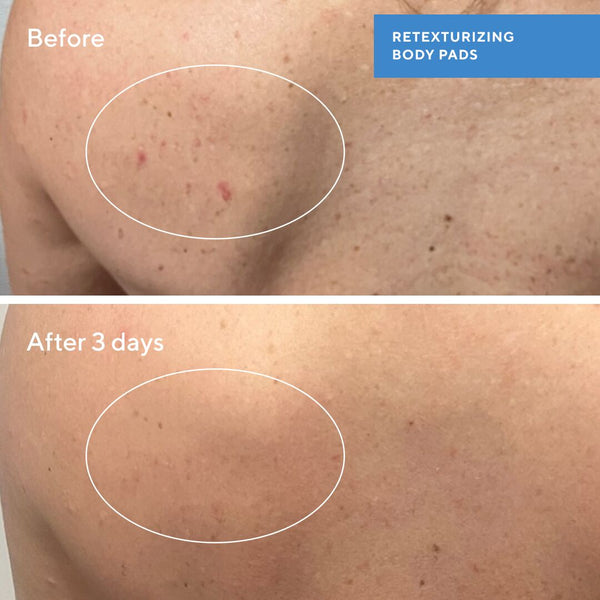 Murad Retexturizing Body Pads