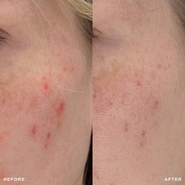 Before and after comparison of skin with redness on a person's face.
