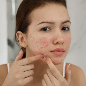 Teenage Acne