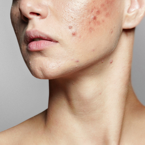 Adult Acne
